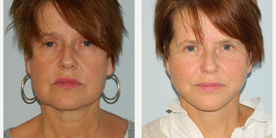 55-64 year old woman treated with Mini Lift - 55-64 year old woman treated with Mini Lift.