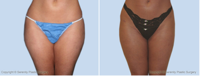 Liposuction  - 
	Liposuction
