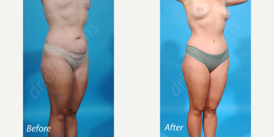35-44 year old woman treated with SlimLipo - Bikini incision abdominoplasty/tummy tuck with rectus diastasis repair and liposuction