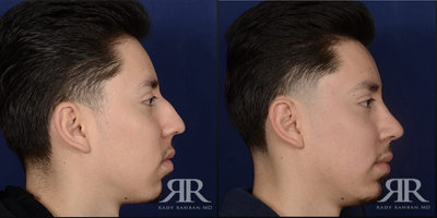 25-34 year old man treated with Chin Implant - chin augmentation