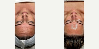35-44 year old woman treated with Botox, HydraFacial - Subtle, natural smoothing achieved with neuromodulator treatment to the forehead and labella. The After image was captured 3 weeks post-Botox and immediately following a HydraFacial treatment. Notice how the fine lines are softened, the skin is more hydrated, and the overall texture is luminous and refreshed. At Beverly Wilshire Aesthetics, we often layer medical and aesthetic treatments intentionally - combining injectables for muscle relaxation and skin-revitalizing therapies for a comprehensive glow.
