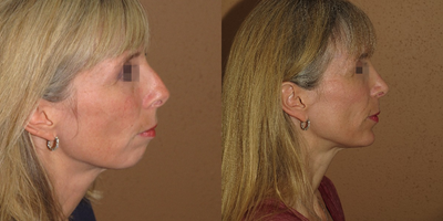 35-44 year old woman treated with Rhinoplasty - Rhinoplasty and Chin Implant