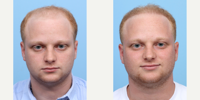 18-24 year old man treated with FUE Hair Transplant, Hair Transplant, Hair Loss Treatment, PRP for Hair Loss - Dr. Wise performed an FUE hair transplant on this 22-year-old patient along with one session of PRP therapy. To achieve the results he was looking for, 3,050 grafts were placed to restore his hairline, with a portion fanned out to add density. The after photos were taken 6 months post-op and show how much coverage he regained and how the hairline was blended in from above the ear for a completely natural look.