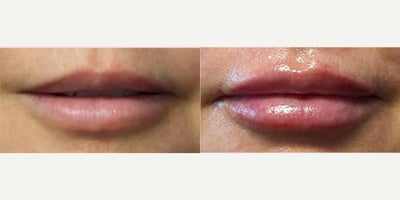 55-64 year old woman treated with Lip Fillers, Juvederm, Volbella, Restylane, Restylane Kysse - Lip augmentation with hyaluronic acid filler (Juvederm, Vollure, Volbella, Voluma, Restylane or Belotero) for balanced natural look & pout