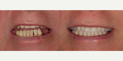 65-74 year old man treated with ClearChoice Dental Implants - Patient presented to our office with a desire to replace missing teeth in the lower jaw and improve appearance of his smile.  Five dental implants were placed on the lower jaw and missing teeth were replaced with a fixed bridge.