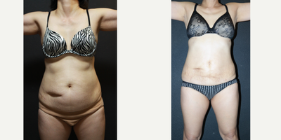 55-64 year old woman treated with Vaser Liposuction - Vaser AWAKE lipo upper and lower abdomen
