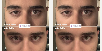 complex revision eyelid ptosis surgery - Young man, with history of failed right upper eyelid ptosis surgery (by another surgeon), underwent complex revision eyelid ptosis repair. Note the significant improvement in his before and after selfie photos.