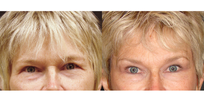 55-64 year old woman treated with Eyelid Surgery - Lower Blepharoplasty