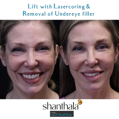 35-44 year old woman treated with Fractional Laser, Laser Resurfacing, Hyaluronidase, Botox - Reversal of Under eye fillers & Laser-coring with Ultraclear