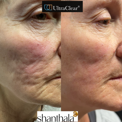 65-74 year Fractional Laser, Laser Resurfacing - Lasercoring with Ultraclear, Subcision combination