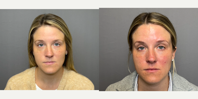 25-34 year old woman treated with Restylane, Lip Fillers - under eye and lips