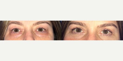 45-54 year old woman treated with Eyelid Surgery - Patient is 2 months post op her blepharoplasty