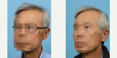 65-74 year old man treated with PicoWay - picoway