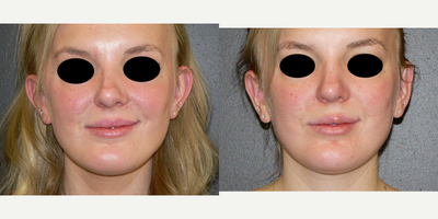 25-34 year old woman treated with Ear Surgery - This patient had otoplasty to correct her prominent ears and ear position asymmetry. This was performed in the office under local anesthesia.