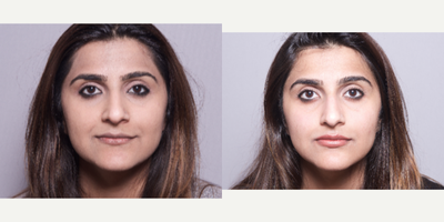 18-24 year old woman treated with Juvederm - 18-24 year old woman treated with Juvederm in her lips