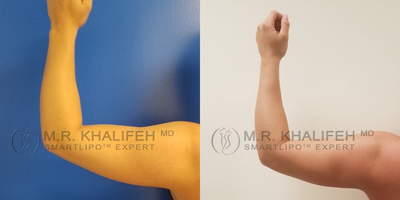 25-34 year old woman treated with Laser Liposuction - Greater definition can be obtained to define the contours of the deltoid, triceps, and the borders of the bicep muscles while doing Arm laser lipo.