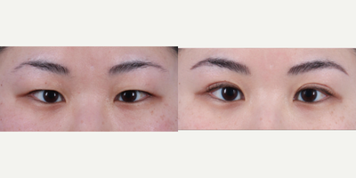 Woman treated with Eyelid Surgery - Upper Blepharoplasty