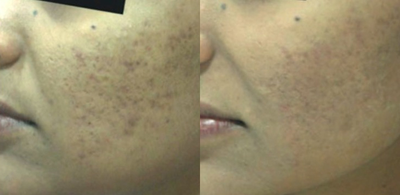 25-34 year old woman treated with Derma Roller - Microneedling with platelet rich plasma (PRP) for acne scarring improvement. After 6 treatments improvement in color, texture, and scarring is noted.