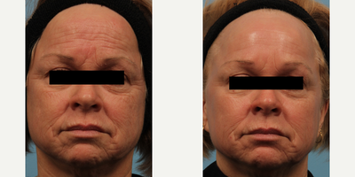 55-64 year old woman treated with Venus Legacy - This client was looking to rejuvenate her face. She was bothered by the lines on her forehead and face and loose skin. She had tried fillers and Botox in the past, but felt it did not provide the longevity she desired.She was not interested in surgical options.
A series of 6 Venus Legacy treatments were completed over 6 weeks. This client saw amazing results and is very pleased.
She continues to come back for maintenance treatments every 4 months to ensure long-lasting results. This client also uses medical-grade skincare to preserve her results and slow any further signs of aging.