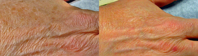 Hand wrinkles treated with Fraxel restore laser - Fraxel restore treatment of hands