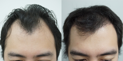 25-34 year old man treated with DHI Hair Transplant, FUE Hair Transplant, Hair Transplant - A middle-aged Asian man came in for a FUE hair transplant with 3,300 grafts to restore his frontal, temples and crown. We also add more grafts on his right temple to cover his surgical scar.