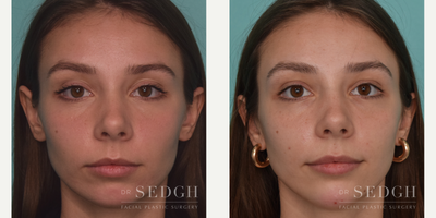 18-24 year old woman treated with Chin Filler - Anatomical and graceful augmentation of the chin with filler can enhance facial aesthetics in a profound way with a 15 minutes lunchtime procedure.