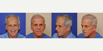 55-64 year old man treated with Hair Transplant - Linear Strip FUT method - Dr. Beaumont is a 64 year old physician who had concerns that his hair loss made him look older than he was. He didnt like how the absence of a frontal hairline made him look, and how others would let their eyes drift up to his hair loss while they were talking to him. He felt his patients were responding to him differently as well. After doing some 3 years of research on hair restoration surgery, Dr. Beaumont underwent a hair restoration surgery, FUT linear strip, with 2,564 follicles transplanted in March of 2016. In March of 2017 he returned for his post-operative photos, and was thrilled with his new look. He says that patients and friends tell him he looks great, and their eyes no longer drift up to where his hairline used to be.&nbsp;