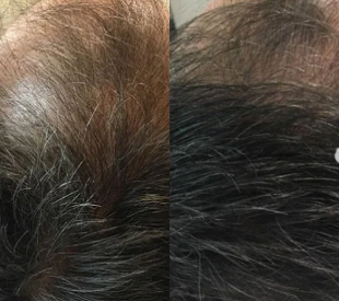 Patient treated with Nutrafol - Patient treated with Nutrafol