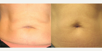 Woman treated with Thermage - Woman treated with Thermage to abdomen