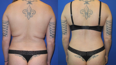 Patient Treated with Back Lift - Bra Line Back Lift.