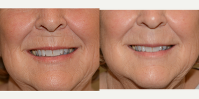 65-74 year old woman treated with Juvederm - 71 year old Female Patient Treated with Juvederm Volbella for Perioral Rhytids (fine lines around the mouth)