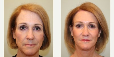 55-64 year old woman treated with Deep Plane Facelift, Facelift, Lip Lift, Lip Surgery, Eyelid Surgery, Brow Lift - Full facial rejuvenation surgery