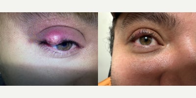 35-44 year old woman treated with Mole Removal - excision of lesion eye