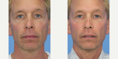 55-64 year old man treated with Venus Freeze (6 treatments) - 55-64 year old man treated with Venus Freeze (6 treatments)