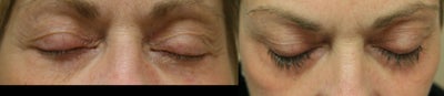 Latisse - 
	Latisse prolongs the growth phase of the hair follicle producing longer, thicker, darker lashes. The solution is applied with a brush.
