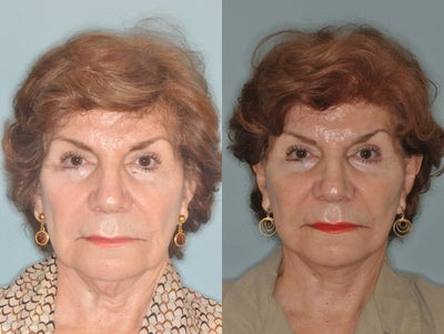 Facelift - 
	Facelift before and after.
