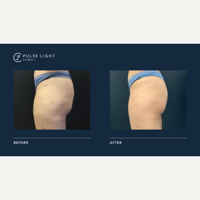 35-44 year old woman treated with Velashape - 35-44 year old woman treated with Velashape on buttocks / bum area