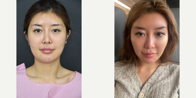 25-34 year old woman treated with Jaw Reduction - My patient wanted a snatched k-pop jawline. This was achieved with shaving the bone and removing the salivary gland.