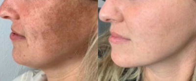 Woman treated with Lumecca - Woman treated with Lumecca