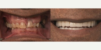 45-54 year old woman treated with All-on-4 Dental Implants, Dental Implants - This patient came to us feeling self-conscious about their smile and hesitant to seek care. After a personalized treatment plan and expert dental implant placement, they now have a natural-looking, fully restored smile. The transformation not only improved function, but gave them the confidence to smile again.