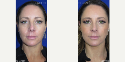 Woman treated with Eyelid Surgery, CO2 Laser, Profound RF - Woman treated with Eyelid Surgery, CO2 Laser, Profound RF