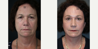 Brows, Eyelids, Facelift and Laser - Deep plane face and neck lift paired with upper and lower eyelid surgery, brow lift and laser.