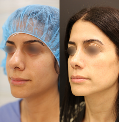 29 year old woman treated with Rhinoplasty - Female patient aged 29 treated with an open rhinoplasty (nose surgery). After photo was taken 9 months post-op.