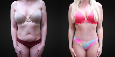 35-44 year old woman treated with Tummy Tuck - This lovely ASA patient is pictured before and 3 months post tummy tuck procedure.