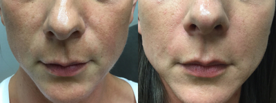 35-44 year old woman treated with Teosyal - Teosyal Filler to Nasolabial folds