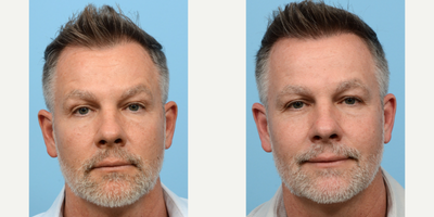 45-54 year old man treated with PRP for Hair Loss - Dr. Wise performed an FUE hair transplant on this 48-year-old patient to round off the corners of hairline and add density to the front. In addition to that, one session of PRP therapy was done during the procedure to strengthen the follicles. One year and 2,015 grafts later, the patient's results look incredible!