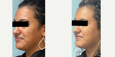 25-34 year old woman treated with Pixel Laser - This client has had problems with hyperpigmentation, acne scars and enlarged pores. After only two Clear Lift treatments she has had significant improvement. Typically 4-6 treatments are recommended however every client's treatment plan is based on there needs.