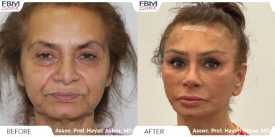 65-74 year old woman treated with Deep Plane Facelift, Facelift, Facial Fat Transfer, Eyelid Surgery, Rhinoplasty, Neck Lift - 65-74 year old woman treated with Deep Plane Facelift, Facelift, Facial Fat Transfer, Eyelid Surgery, Rhinoplasty, Neck Lift