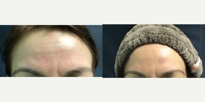 25-34 year old woman treated with Pelleve - Before 1st and 3rd treatment on forehead