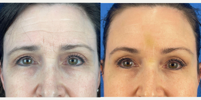 45-54 year old woman treated with Xeomin - Xeomin used on this 54 year-old patient to lessen appearance of glabeller, crows feet and forehead lines. Improvement shown one week after treatment.